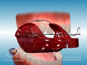 ScreenPlay Orthodontic Education Videos: Bionator Appliance