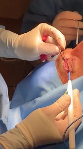 Upper and lower eyelid surgery