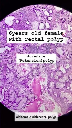 JUVENILE POLYP (RECTUM) /HISTOPATHOLOGY