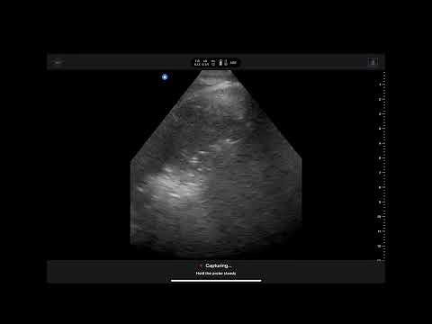 Overview of Butterfly IQ3 ultrasound probe