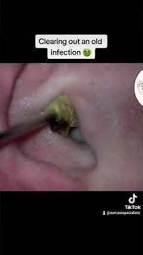 Old ear infection: debris and discharge removal #earcleaning #earcarespecialists #microsuction