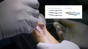 Fusion of the MTP-1 Joint for a Grade 4 Hallux Rigidus