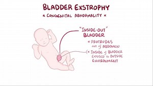 Video: Bladder exstrophy - Video Explanation! | Osmosis | Osmosis