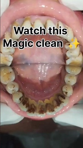 “Clean teeth, fresh breath, and healthy gums — all start with tartar removal. 💫 👋✨”