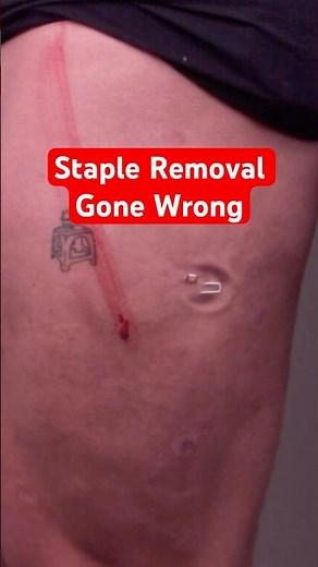 Staple Turned My Leg Into a Fountain 😱 #shorts #funny #entertainment