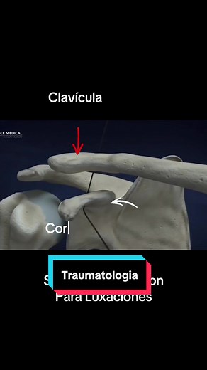 Tratamiento de Luxación con Sistema Endobutton en Ecuador