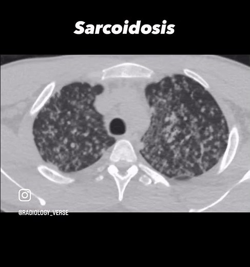 HRCT Thorax in Sarcoidosis | Classic Radiological Findings Explained.