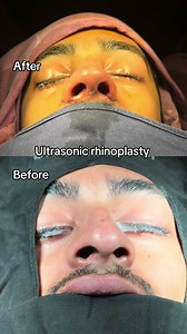 Ultrasonic Rhinoplasty Before & After