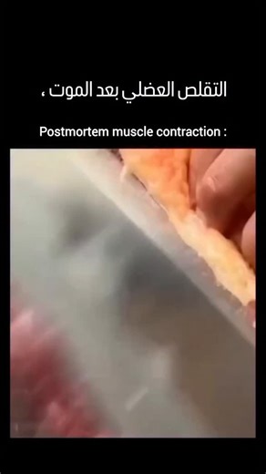 After death, postmortem muscle contraction refers to the stiffening or occasional twitching of muscles due to biochemical changes in the body. The main types are: Cadaveric spasm (instantaneous rigor) 🫱 Occurs immediately at the moment of death. Muscles stiffen instantly without a relaxation phase. Often seen in cases of sudden or violent death (e.g., drowning, combat). May cause the body to “freeze” in the last act (e.g., holding an object tightly). Rigor mortis (true postmortem rigidity) 💀 A