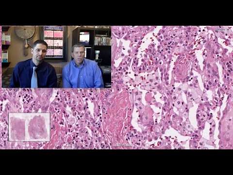 Pattern 4 - Fibrosing Organizing Pneumonia