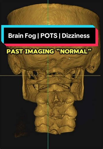 Patient traveled to our office for a Two-Day Travel Intensive to get answers for persistent POTS symptoms, vertigo, and brain fog. Using a 3D CBCT scan, we analyze the structural alignment of the upper neck — the area where the brainstem, major blood vessels, and nerves travel between the brain and body. When this region becomes misaligned (often after a past injury, fall, concussion, or car accident), it can interfere with: • Vagus nerve function (autonomic regulation) • Vestibulocochlear nerve