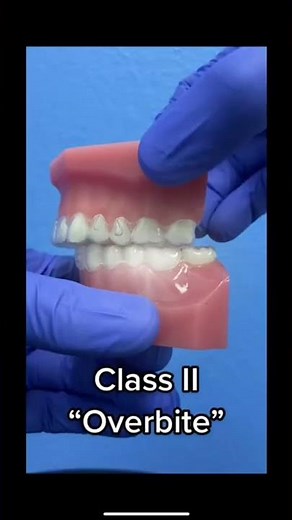 The 4 types of Bites!