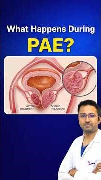 PAE Procedure Explained Step-by-Step | Hospital Stay & Recovery