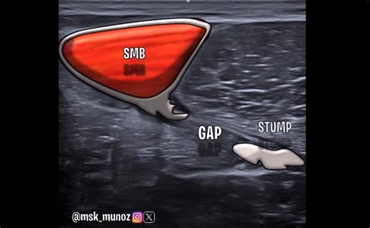 JP Munoz • MSK on Instagram: "SEMIMEMBRANOSUS - TENSION LOSS ULTRASOUND: Rupture of the proximal tendon. Waviness of the proximal stump easily depicted on longitudinal scan, not so overt in axial images. #ultrasound #msk #sportsimaging #sportsmedicine #hamstring"