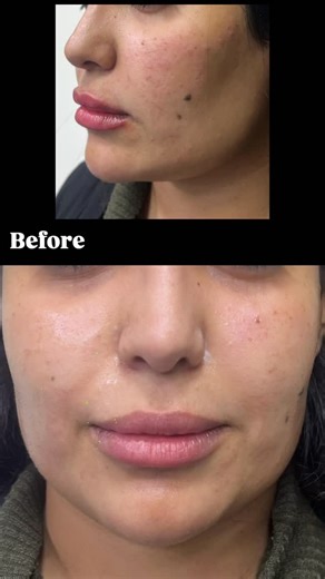 Face contouring and augmentation done by Dr.Hamzha Nofal. #filler #facelift #botox #palestine #qatar | Allure Laser Clinic