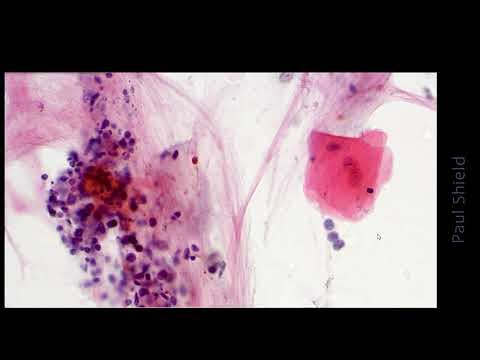 Small cell carcinoma