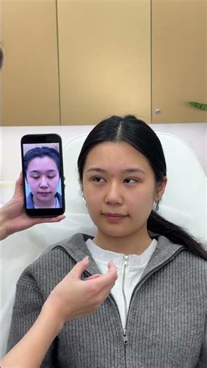 thread double eyelid 双眼皮埋线 consult