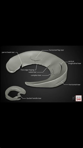 🦵 Meniscus Anatomy Explained: Medial vs Lateral #anatomy #kneepain #ATC #meded #ortho