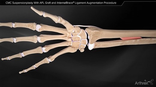 CMC Suspensionplasty With APL Graft and InternalBrace™ Ligament Augmentation Procedure