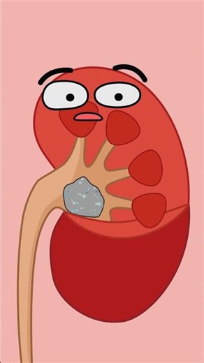 What's REALLY Causing Your Kidney Stones?