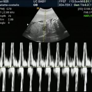 WOW! Listen to the sound of an unborn baby's beating heart! | LifeNews.com