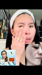 My solution po ang melasma pikas! | Shangme skin care shop