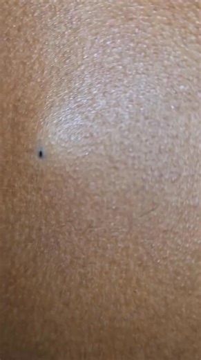 6.1K views · 18 reactions | Punctum_Sebacous Cyst | Pimple 2022 | Facebook
