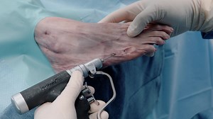 Minimally Invasive Correction of a Type 2 Tailor’s Bunion Using a Compression FT Screw