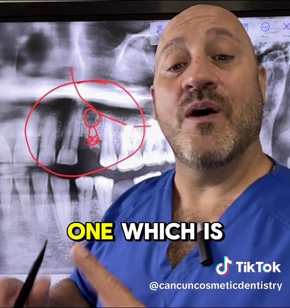 You don't know how many patients have broken teeth and don't realize that there's still a piece of the root embedded in the bone. Look, here's a small piece of the root. What’s going to happen in that area? In most cases, what starts to happen is an infection. These infections are located near the sinus. See how we have a sinus here? We don’t want an infection from a broken molar or a broken tooth entering the sinuses because this also connects to the eyes, the nose, and the ears. And we don't w