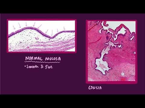 Chronic cholecystitis causes, symptoms, diagnosis, treatment, & pathology