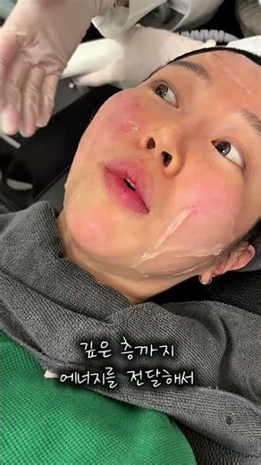 Ultracine Lifting: 1-Week Results, Double Chin Lifting #LiftingEffects #Ultracine