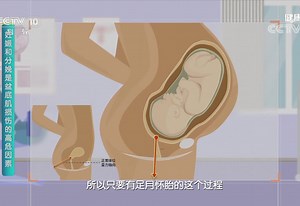 你听说过子宫脱落吗？是什么导致了盆腔脏器脱垂的发生？