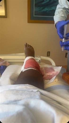 Destineé Spruell on Instagram: "This is PASH Syndrome. Pyoderma gangrenosum. Acne. Suppurativa Hidradenitis. Three names… one brutal, rare, misunderstood diagnosis. Most doctors haven’t even heard of it — so imagine how long it took me to be believed. PASH Syndrome isn’t just skin deep. It’s painful open wounds that take months to heal. It’s biopsies that leave you bleeding for days. It’s navigating life with scars that tell a story no one wants to hear. It’s realizing that your immune system ha