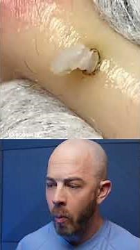 Satisfying Pimple Pop Reaction Compilation! #satisfying #pimplepopper