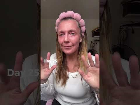 Sharon’s Real CO₂ Laser Recovery (Part 2) – Day 13 to 6 Weeks | Fully Ablative CO₂ with Dr H