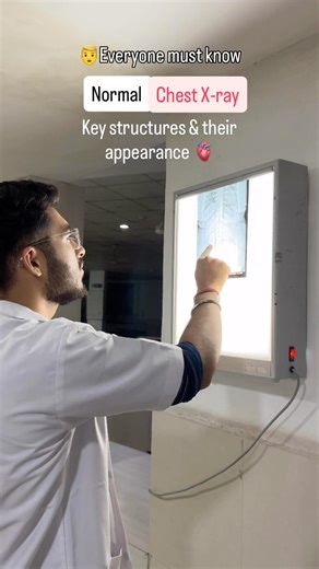 Dr. Vaibhav Mehta on Instagram: "Everyone especially Medical Students & Doctors must be familier with Normal Chest Xray structures 🩻🫀🫁 . . . #XRayVision #WhatsInTheChest #SpotTheStructures #MedSchoolStruggles #RadiologyVibes #StudyWithMe #FutureDocEnergy #ChestXRay101 #DoctorInProgress #MedLifeUnfiltered #StudentDoctorDiaries #LearnMedicineTogether #XRayExplained #MedReels #RelatableMed #MedicalReels #MedEd #Radiology #ChestXRay #XRayAnatomy #MedicalEducation #HealthcareLearning #mbbs #médica