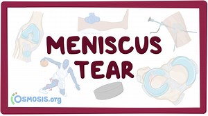 Meniscus tear: Video, Causes, & Meaning | Osmosis