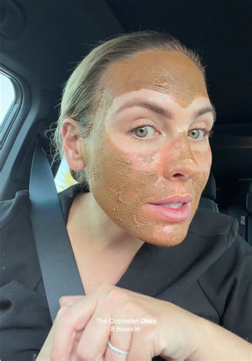 My Cosmelan Peel Diary: 8 Hours Update