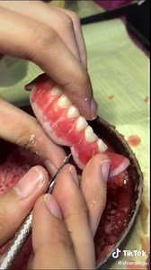 Setting Complete Denture | Dental Student Milestone