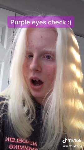 Exploring the Beauty of Albinism: Purple Eyes Unveiled