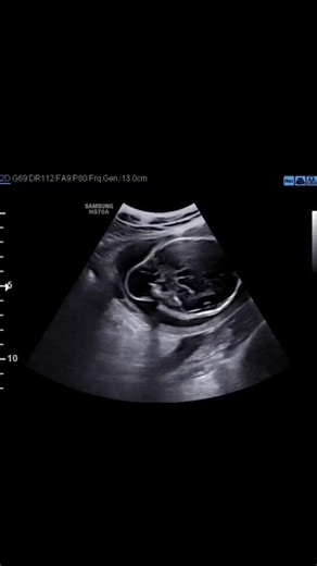 Darrow on Instagram: "🧠✨ Fetal Occipital Meningo-Encephalocele – Antenatal Detection Matters. A rare but crucial neural tube defect where meninges and brain tissue herniate through an occipital skull defect, forming an extracranial sac. Early fetal ultrasound plays a key role in diagnosis, parental counselling, and perinatal planning. 🔍 Key USG Clues: • Occipital calvarial defect • Extracranial cystic / mixed sac • Continuity with intracranial contents 📌 Prognosis depends mainly on sac conten