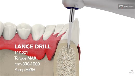B B Dental Drilling protocol - D1-D2 bone - 3P implant line