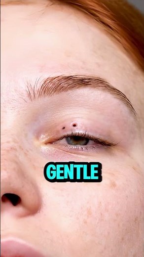 Most Satisfying Eyelid Blackhead Removal Ever!