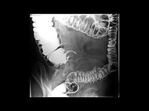 Barium Enema Examinations