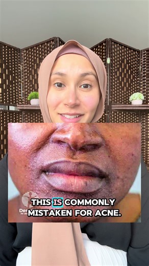 This is commonly mistaken for acne. This is periorificial dermatitis, or POD. POD can look like acne bumps around the mouth, nose, and eyes, and for this reason, is often misdiagnosed. So what causes it? POD most commonly affects middle-aged women, though children and older adults can get it too. A recent review identified three underlying problems: a damaged skin barrier, overgrowth of organisms that normally live on the skin, and environmental triggers. The environmental triggers are wide-rang