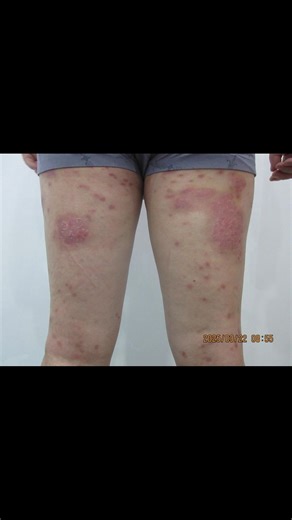 Top Psoriasis Cream for Sensitive Skin Relief