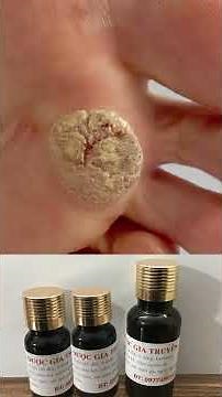 Cách Hết Mụn Cóc Dùng Thuốc Gì Nhiều Người Không Biết?