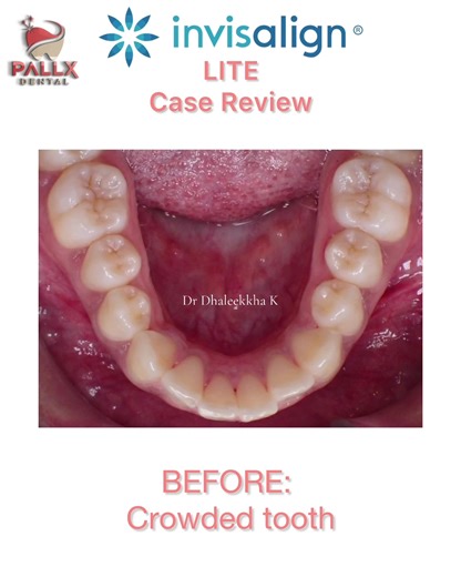 Invisalign Lite Package: Case Review Achieved: ✅Broader Smile ✅Aligned Teeth Minor fixes that gives you a fuller smile #invisalignjb #invisalign #dentalclinicjb