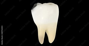 3D animation of a tooth decay with alpha layer