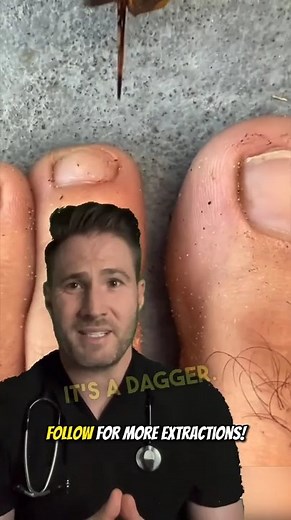 Insanely large splinter removal. #splinterremoval #cystpopping #splinter #foreignbody #erdoctor | Doctor Joe